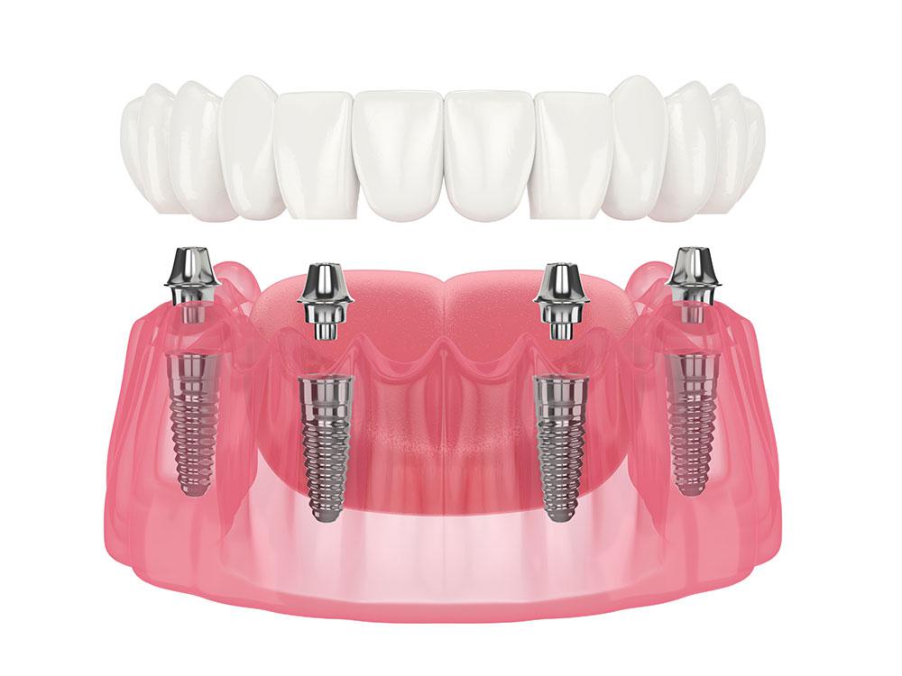 All you need to know about All-on-4 dental implants